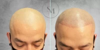 Hairline 3