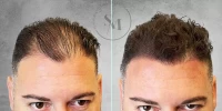 Scar Camouflage 2